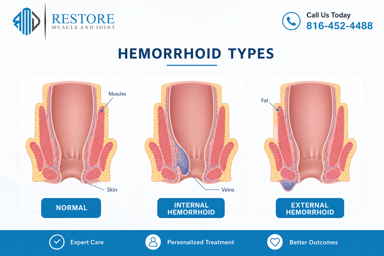 Diagram comparing normal anatomy, internal hemorrhoids, and external hemorrhoids