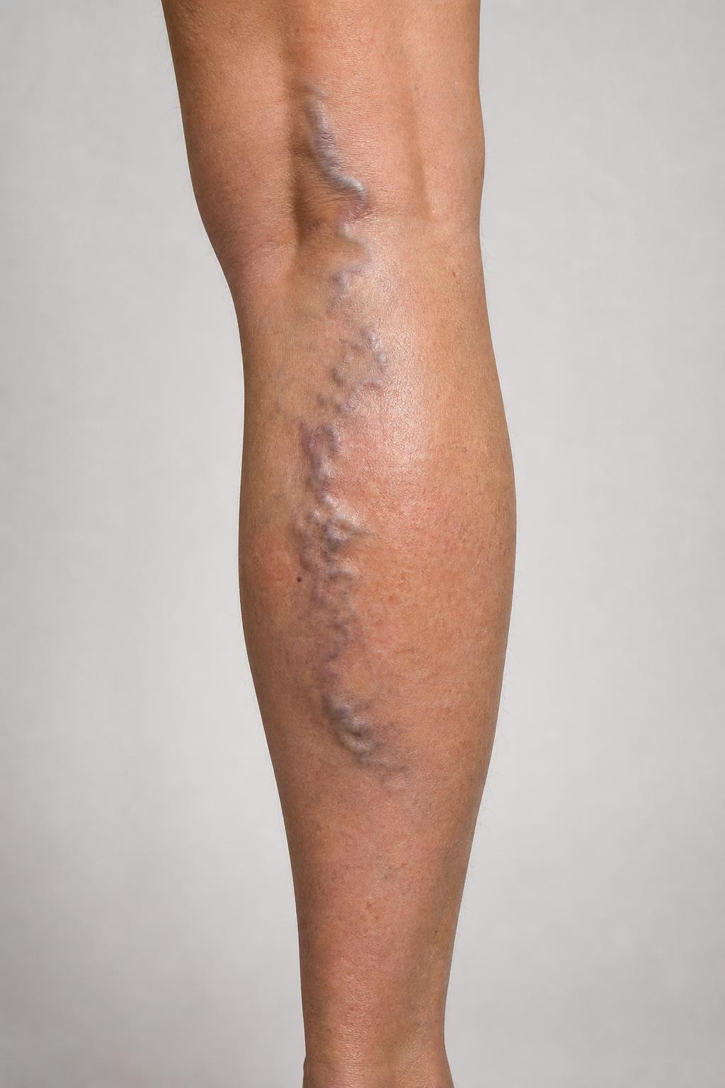 Varicose Veins — Calf before treatment